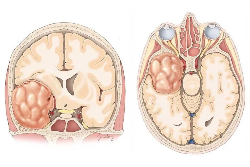 Spontaneous cerebrospinal fluid (CSF) rhinorrhea